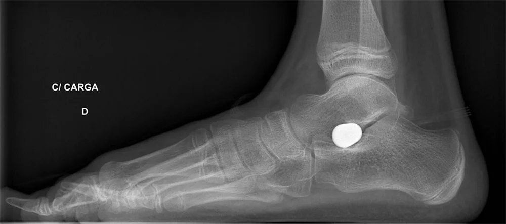 radiografia_do_procedimento_de_Artorrise