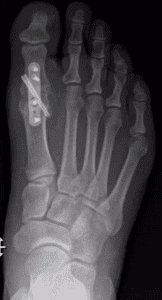 Radiografia demonstrando artrodese da articulação metatarsofalangeana do hálux